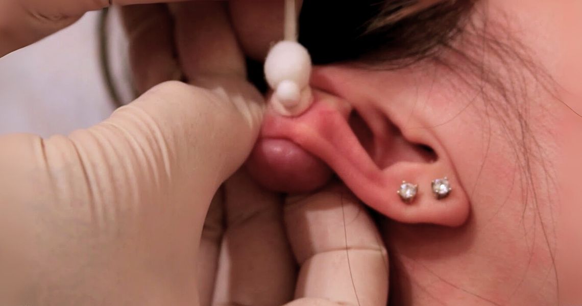 How to get rid of a keloid on my ear