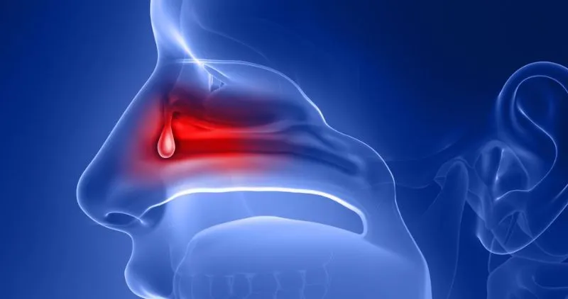 Nasal Polyps Vs Nasal Tumors Key Differences Explained