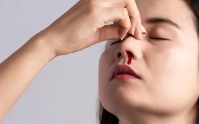 Recurrent Nose Bleeding Treatment Without Surgery